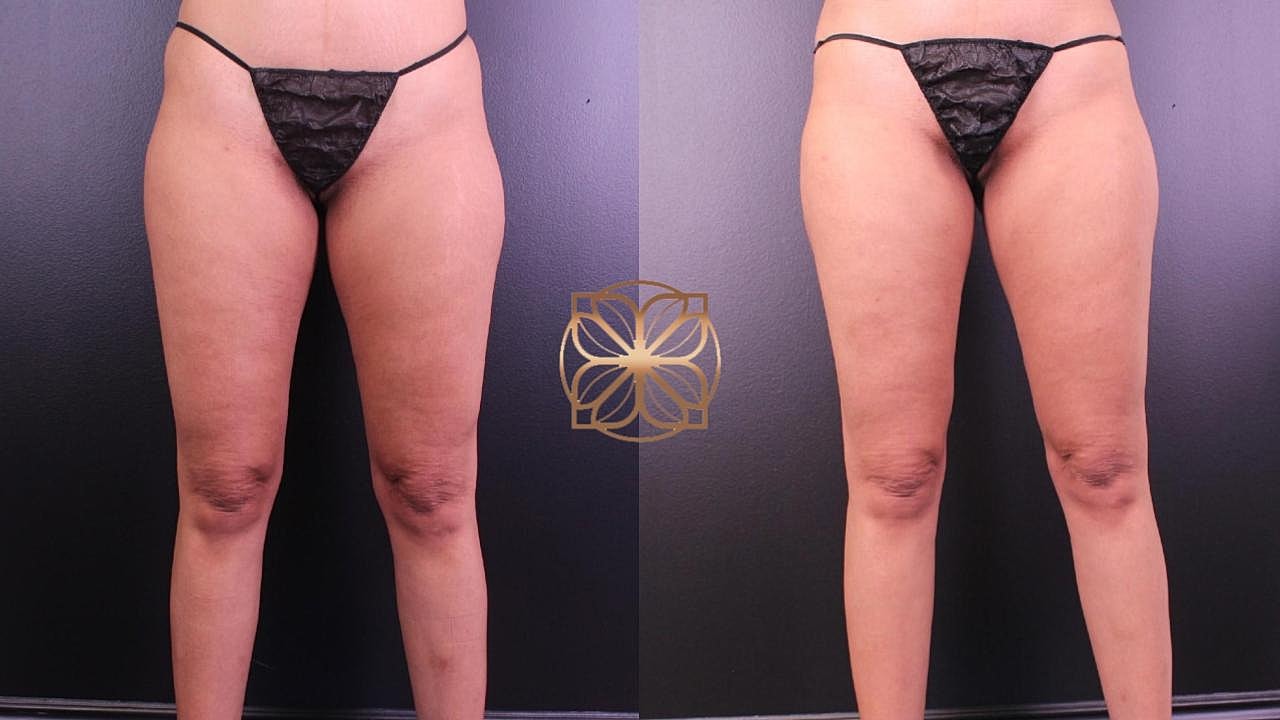 Coolsculpting Gallery Before & After