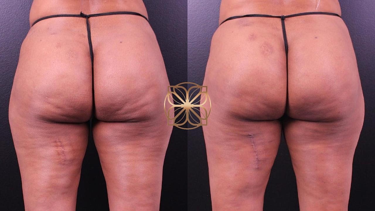 Coolsculpting Gallery Before & After
