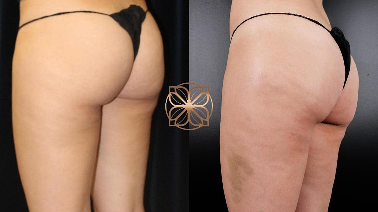 Coolsculpting Gallery Before & After