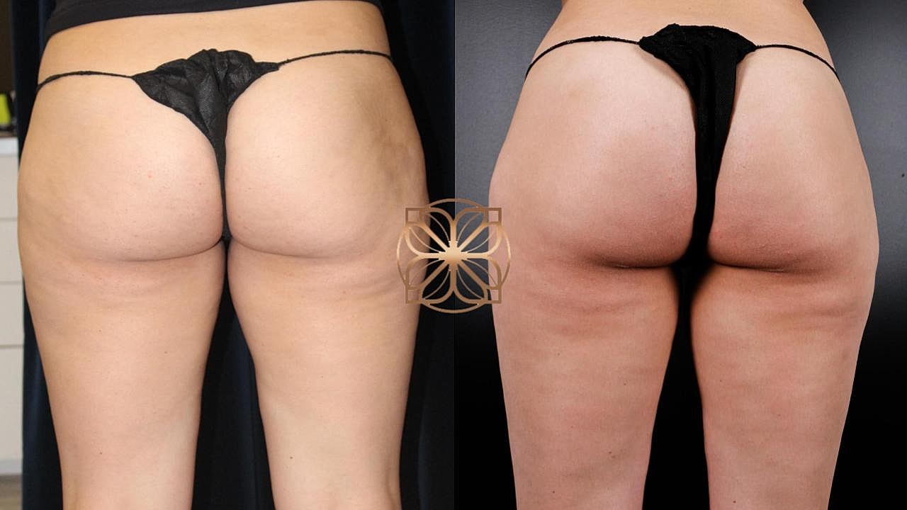 Coolsculpting Gallery Before & After