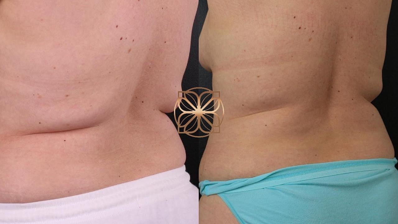 Coolsculpting Gallery Before & After