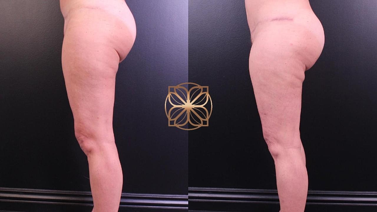 Coolsculpting Gallery Before & After