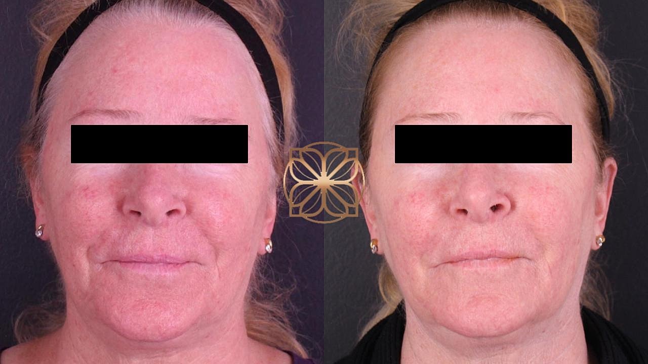 Laser Gallery Before & After