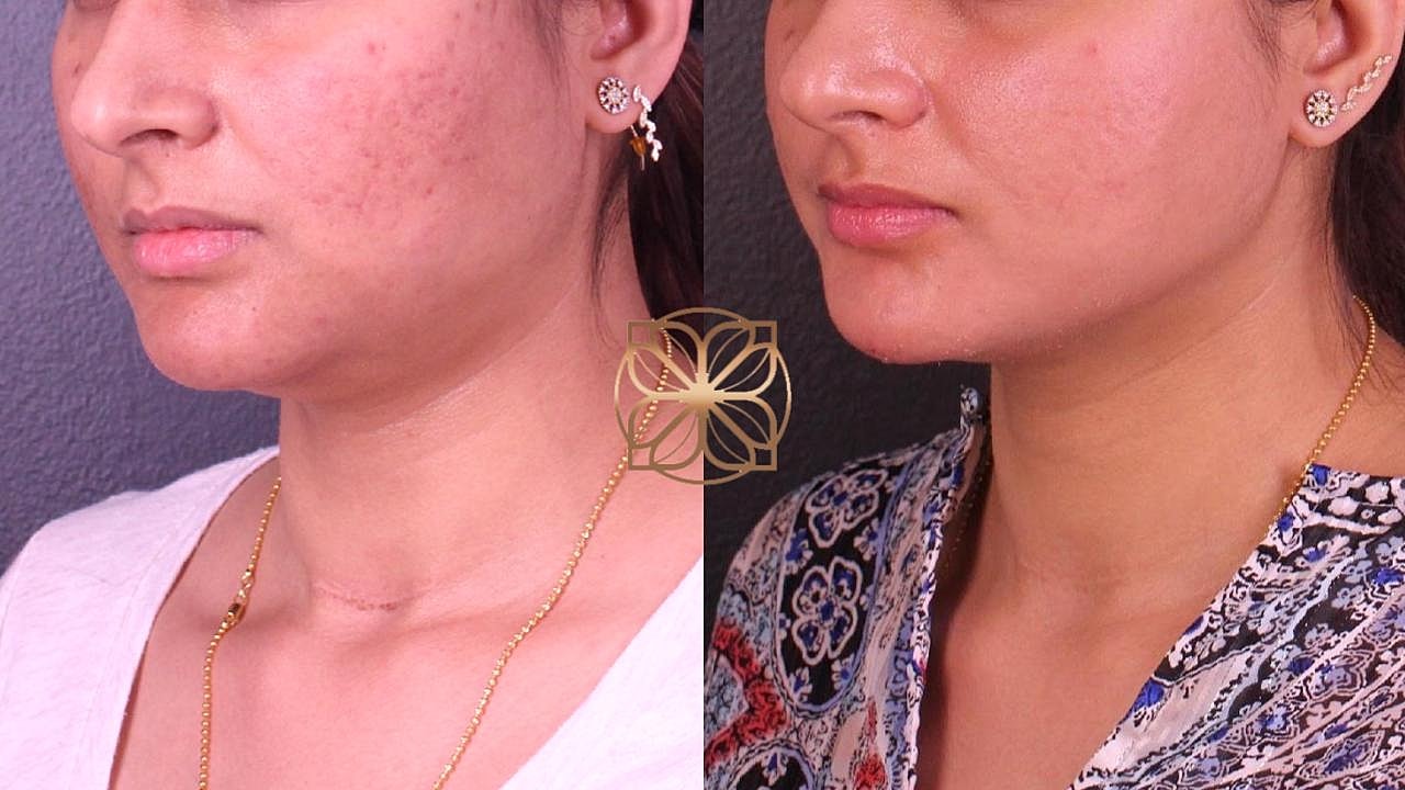 Laser Gallery Before & After