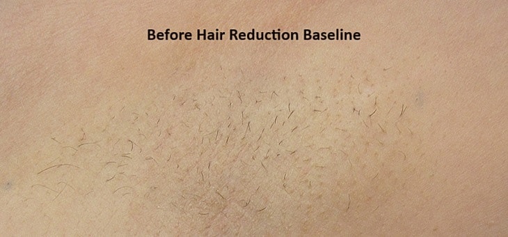 Laser Gallery Before & After