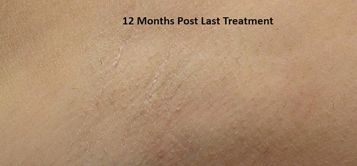 Laser Gallery Before & After