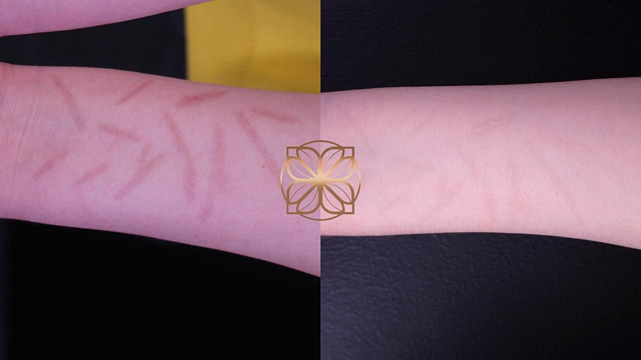 Laser Gallery Before & After