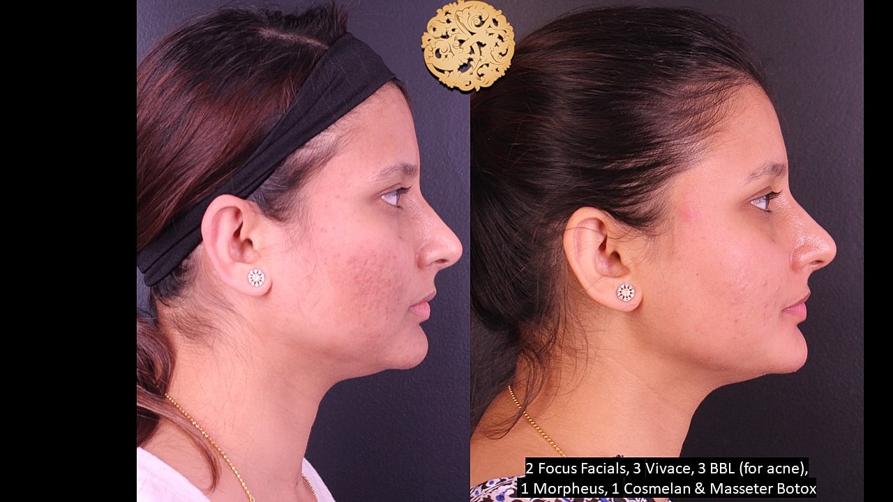 Skin Rejuvenation Gallery Before & After