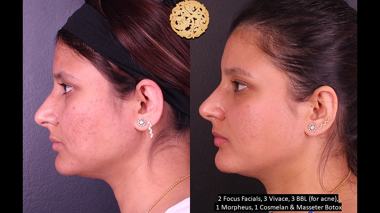 Skin Rejuvenation Gallery Before & After