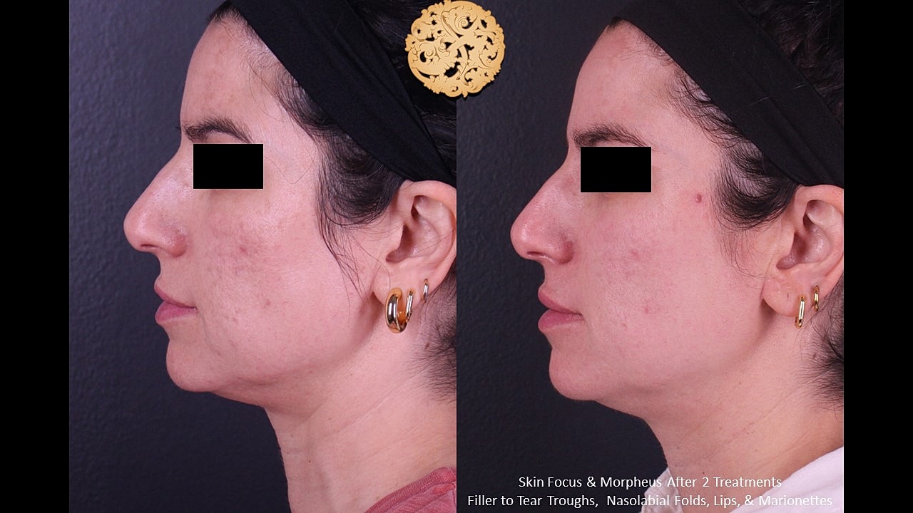Skin Rejuvenation Gallery Before & After