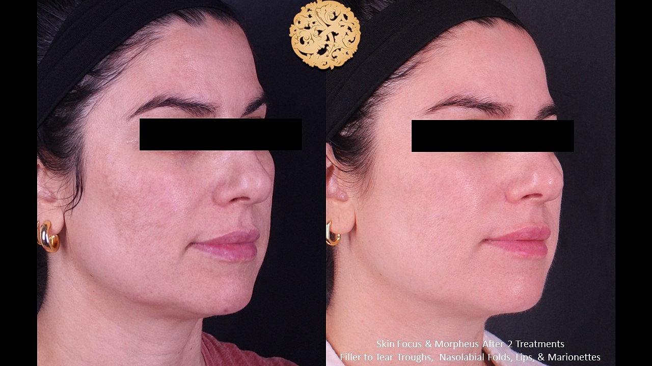Skin Rejuvenation Gallery Before & After