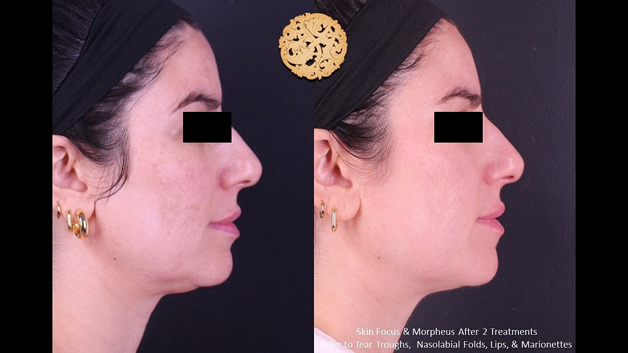 Skin Rejuvenation Gallery Before & After