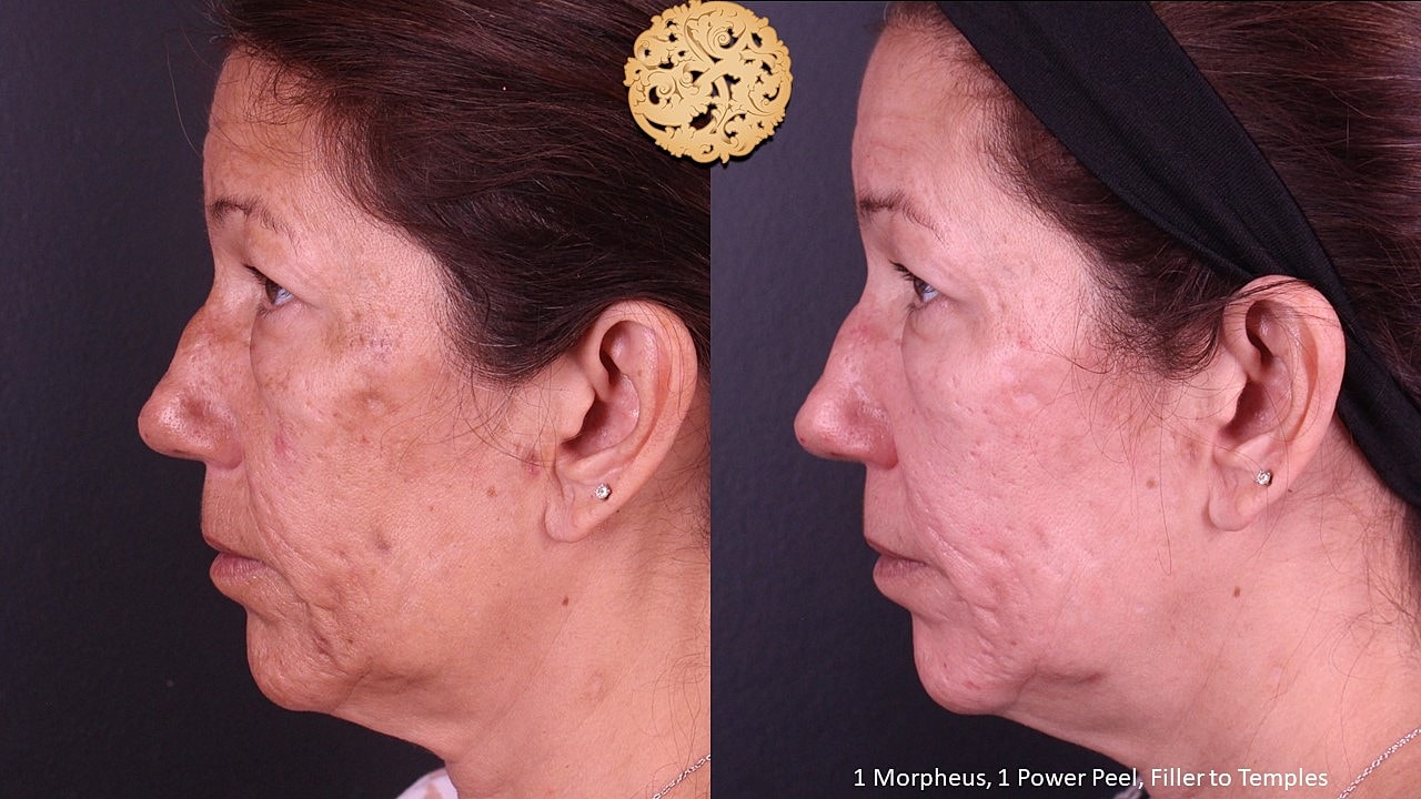 Skin Rejuvenation Gallery Before & After