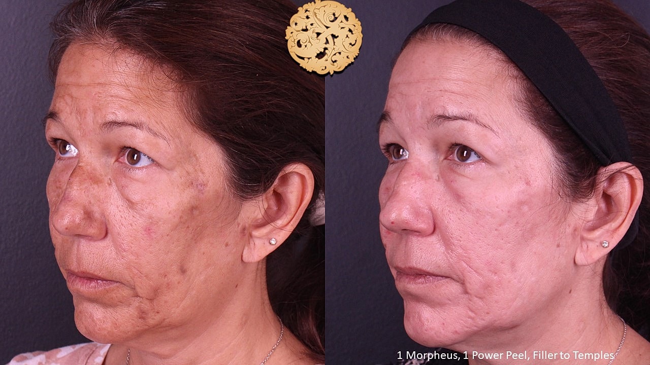 Skin Rejuvenation Gallery Before & After