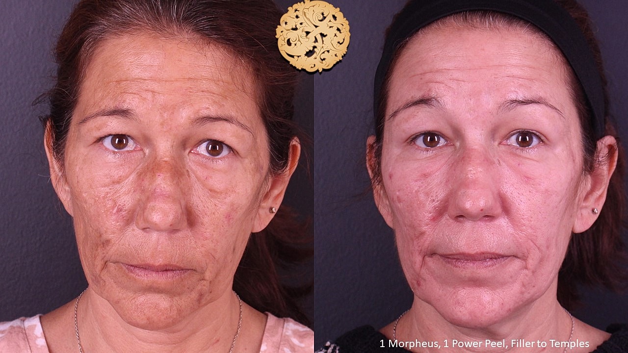 Skin Rejuvenation Gallery Before & After