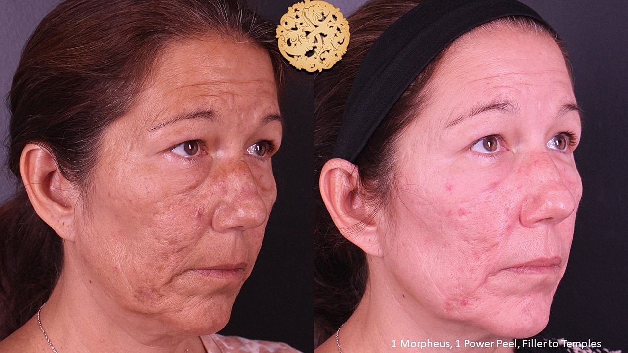 Skin Rejuvenation Gallery Before & After