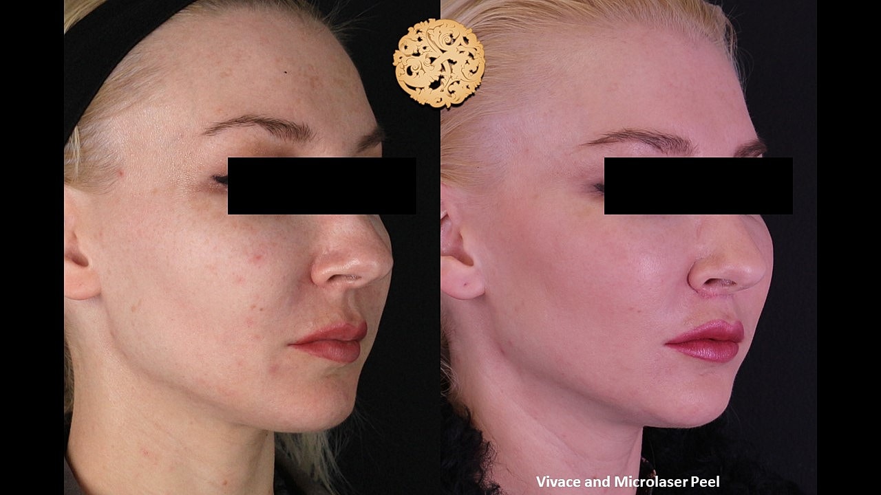 Skin Rejuvenation Gallery Before & After