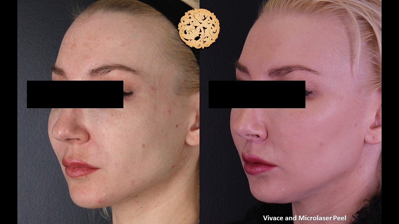 Skin Rejuvenation Gallery Before & After