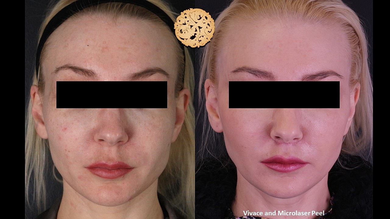 Skin Rejuvenation Gallery Before & After