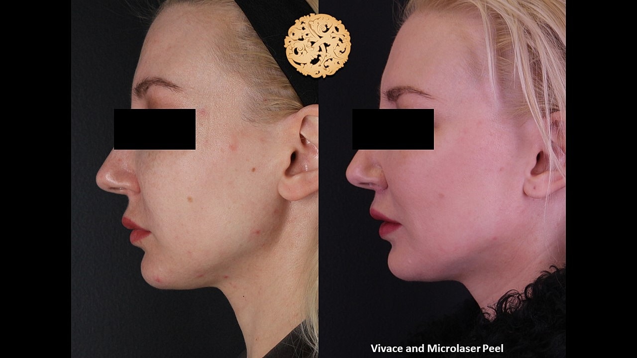 Skin Rejuvenation Gallery Before & After