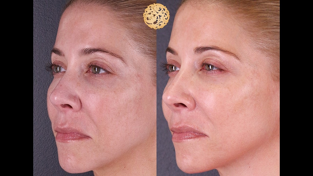 Skin Rejuvenation Gallery Before & After
