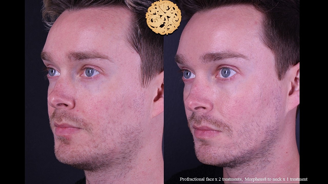 Skin Rejuvenation Gallery Before & After