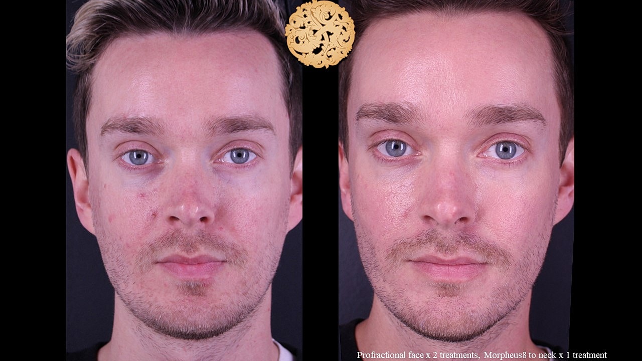 Skin Rejuvenation Gallery Before & After