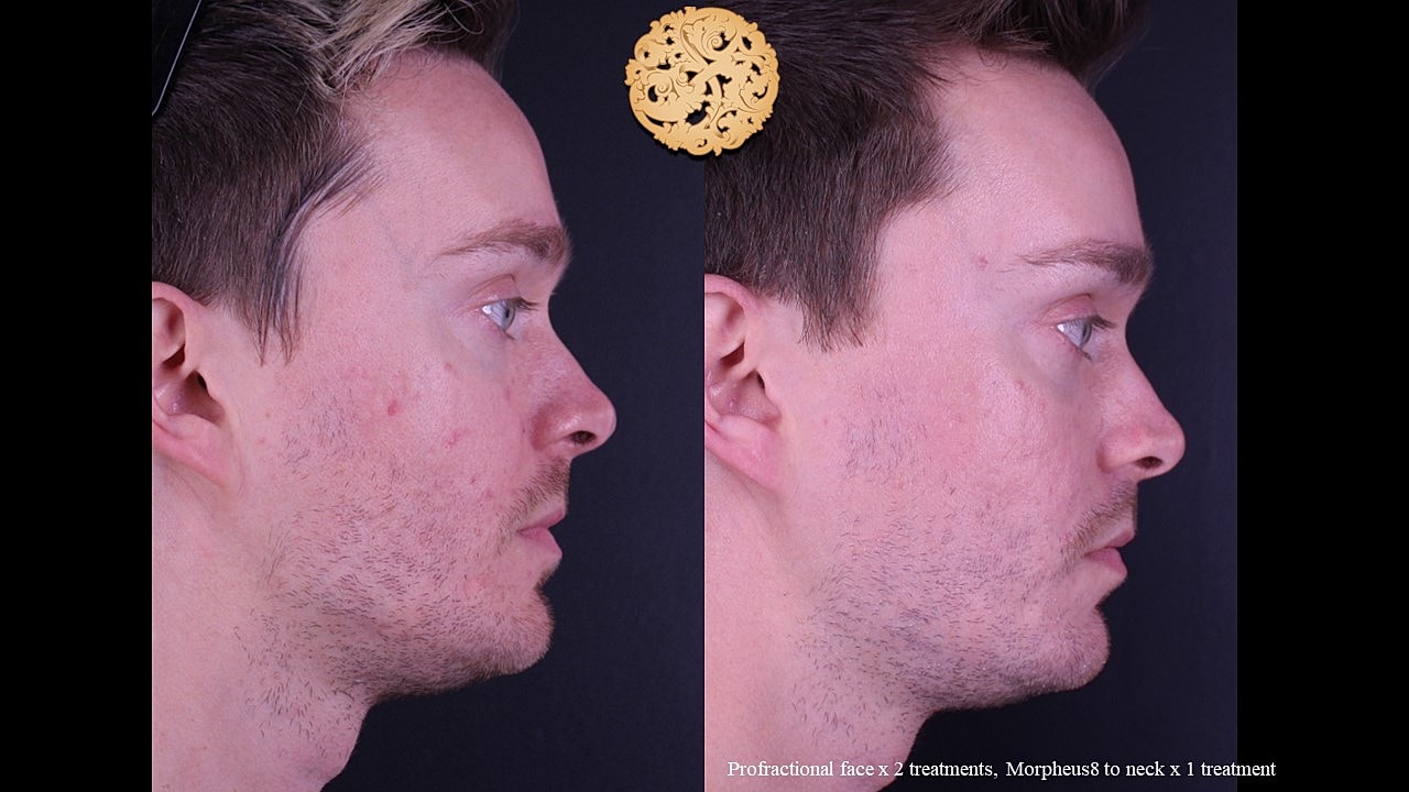 Skin Rejuvenation Gallery Before & After