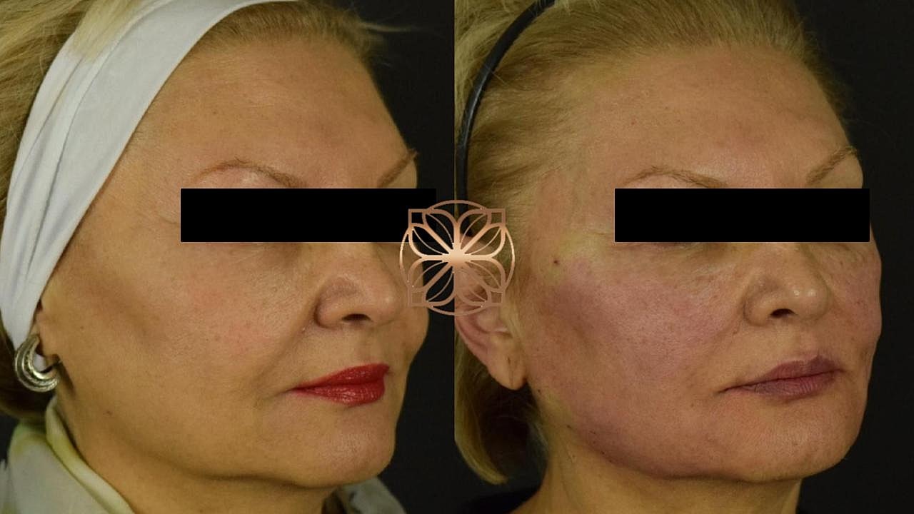 Skin Rejuvenation Gallery Before & After