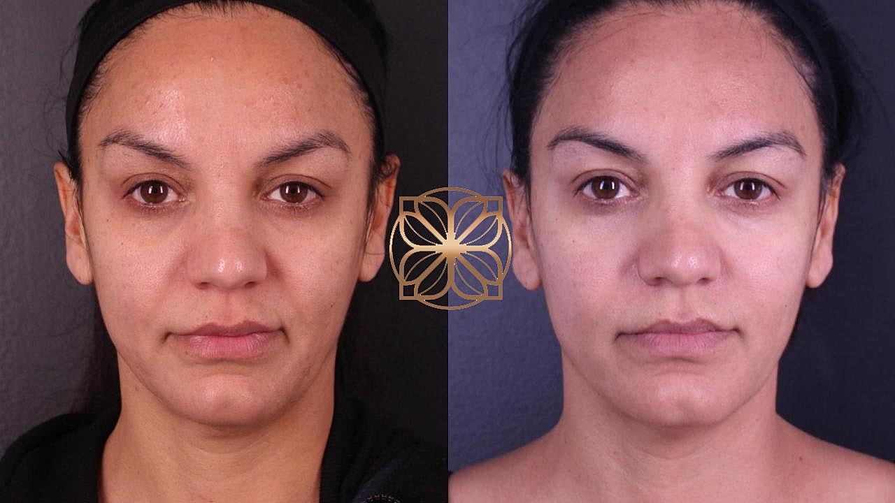 Skin Rejuvenation Gallery Before & After