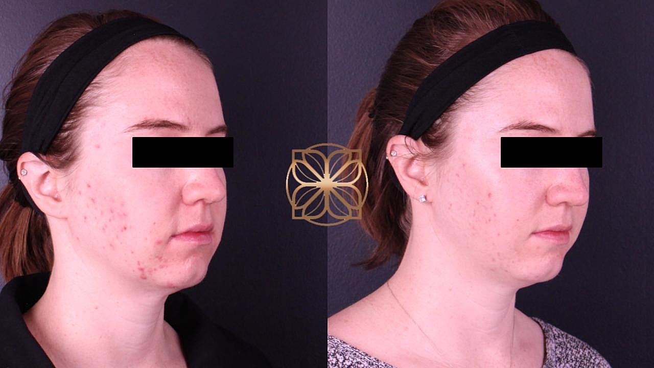 Skin Rejuvenation Gallery Before & After