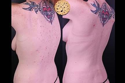 Skin Rejuvenation Gallery Before & After