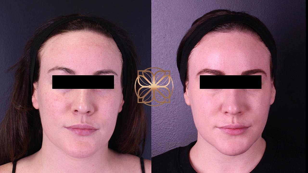 Skin Rejuvenation Gallery Before & After