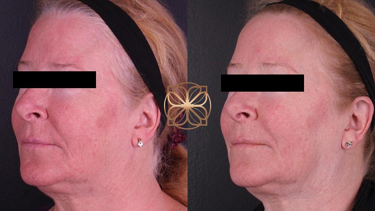 Skin Rejuvenation Gallery Before & After
