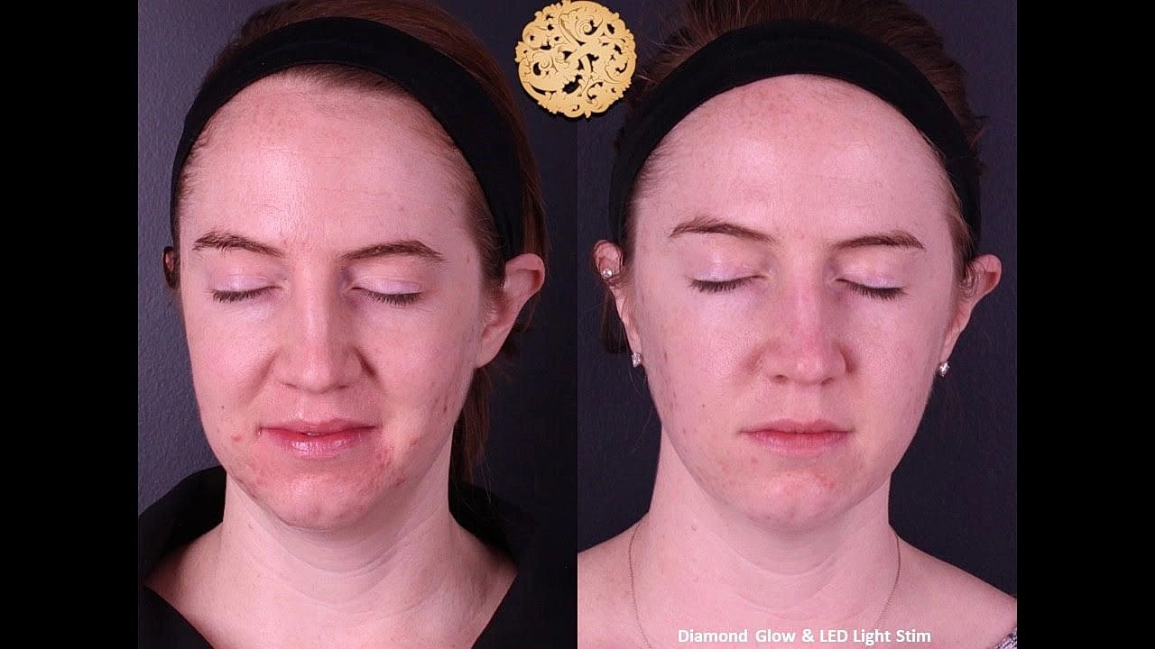 Skin Rejuvenation Gallery Before & After
