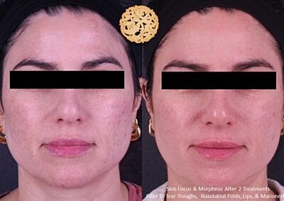 Skin Rejuvenation Gallery Before & After