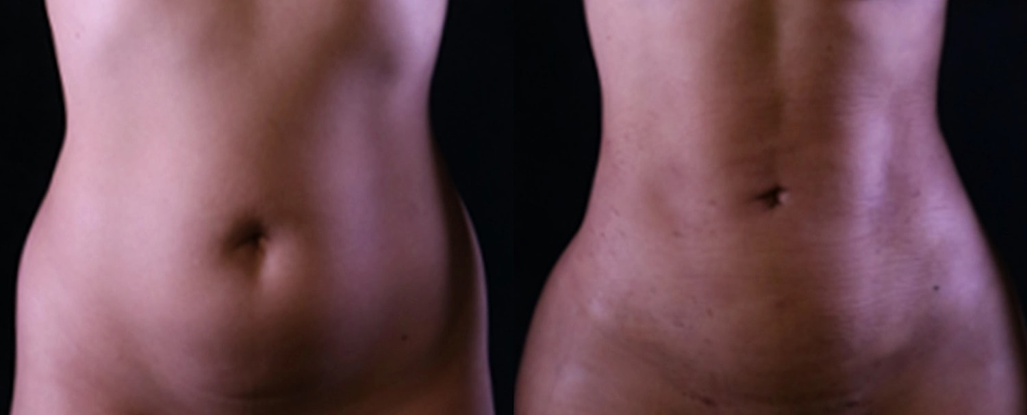 Skin Rejuvenation Gallery Before & After