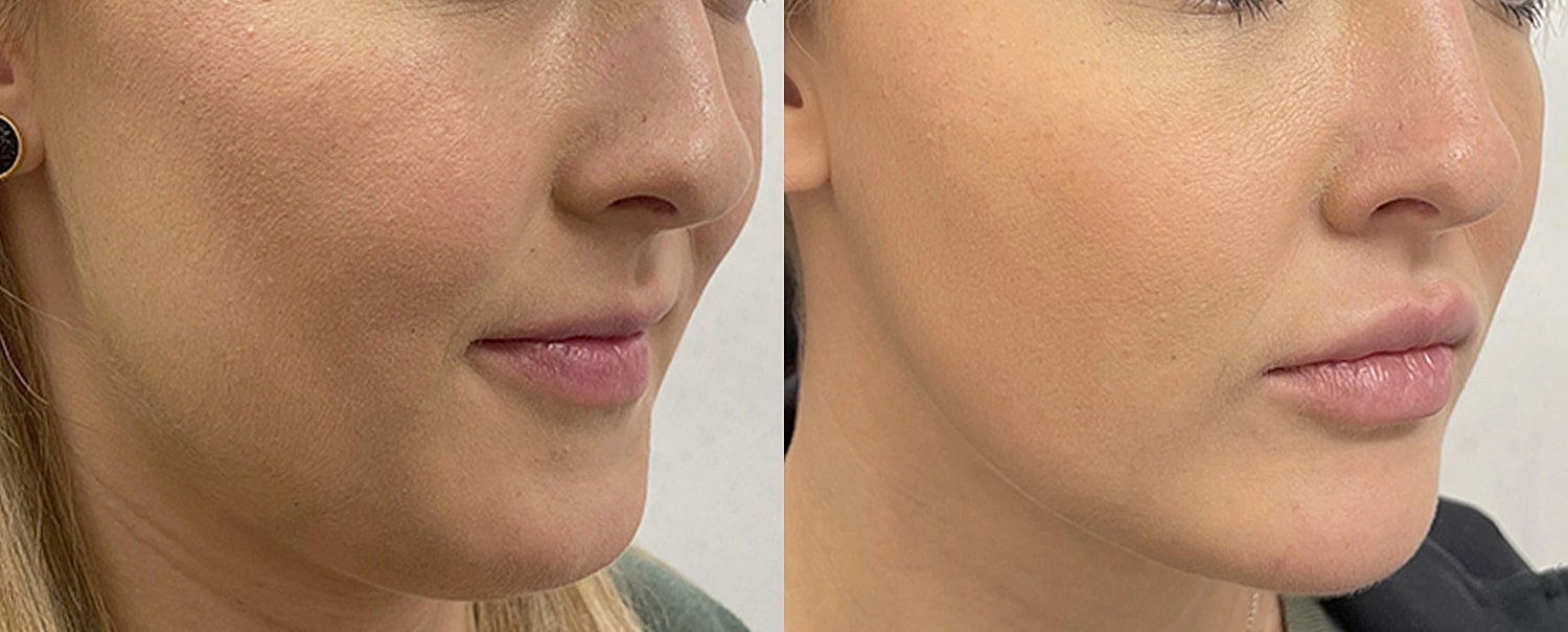 Skin Rejuvenation Gallery Before & After
