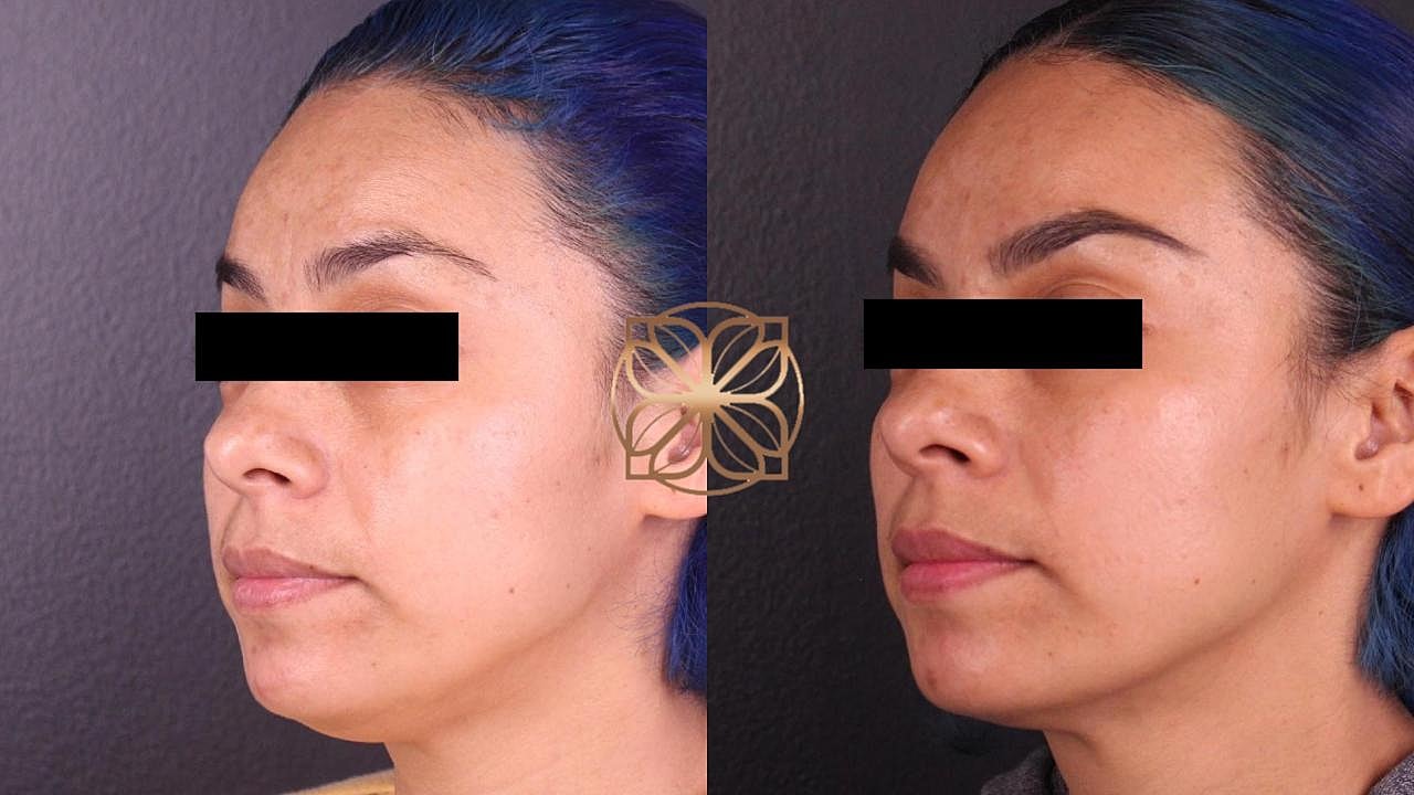 Injectables Gallery Before & After
