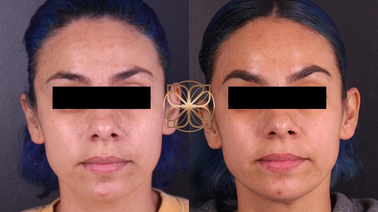 Injectables Gallery Before & After