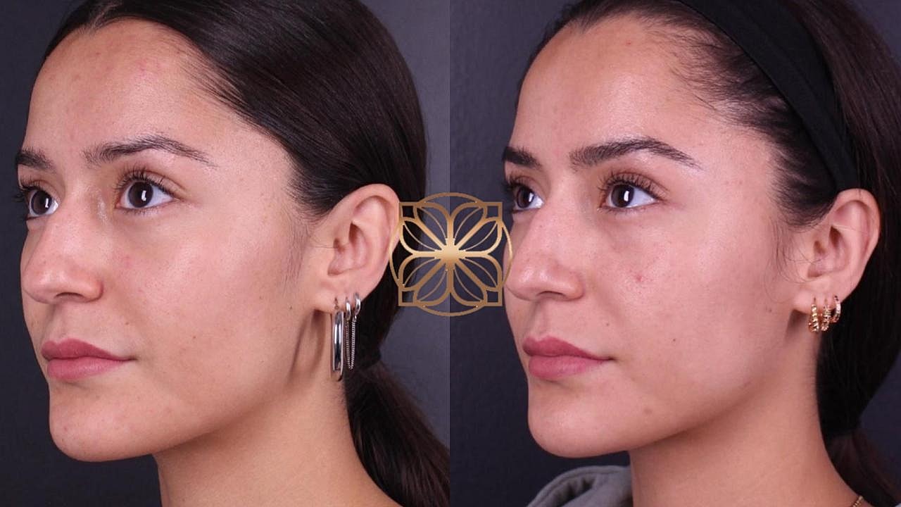 Injectables Gallery Before & After