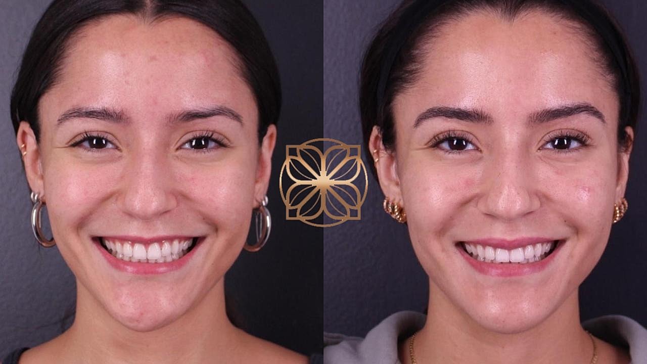 Injectables Gallery Before & After