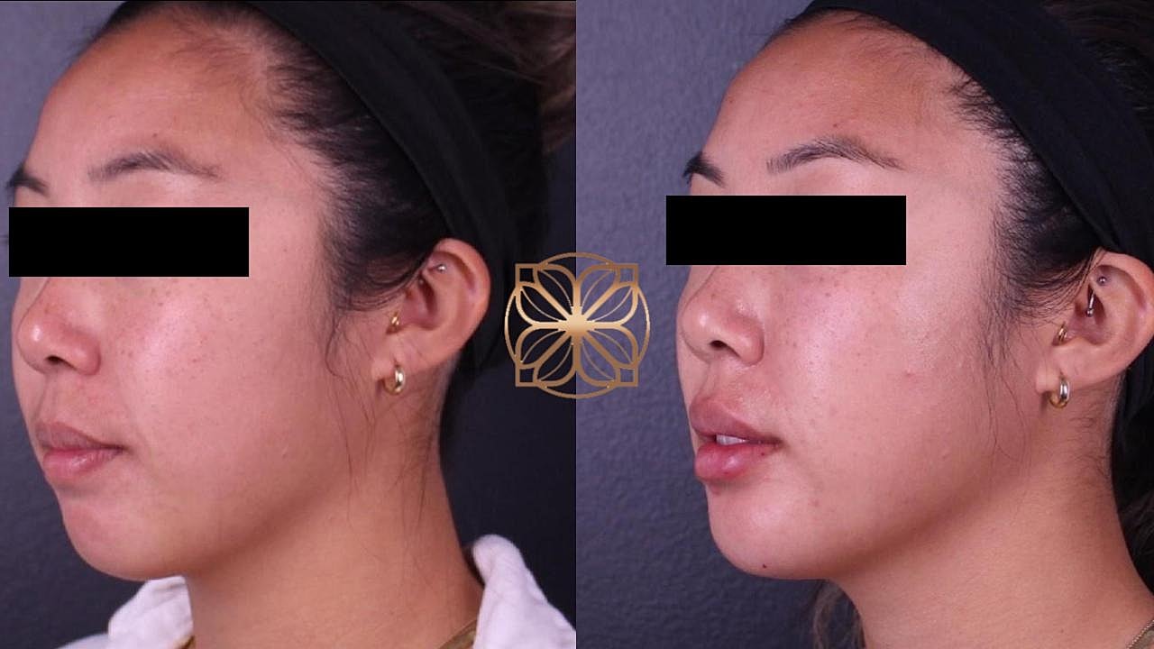 Injectables Gallery Before & After