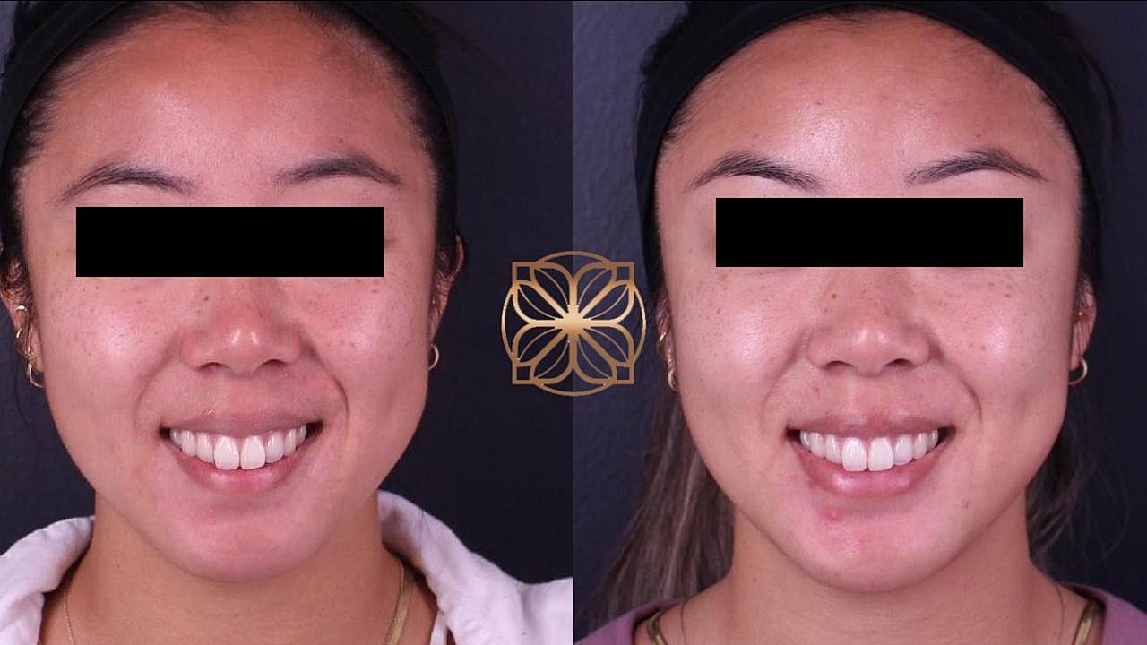 Injectables Gallery Before & After