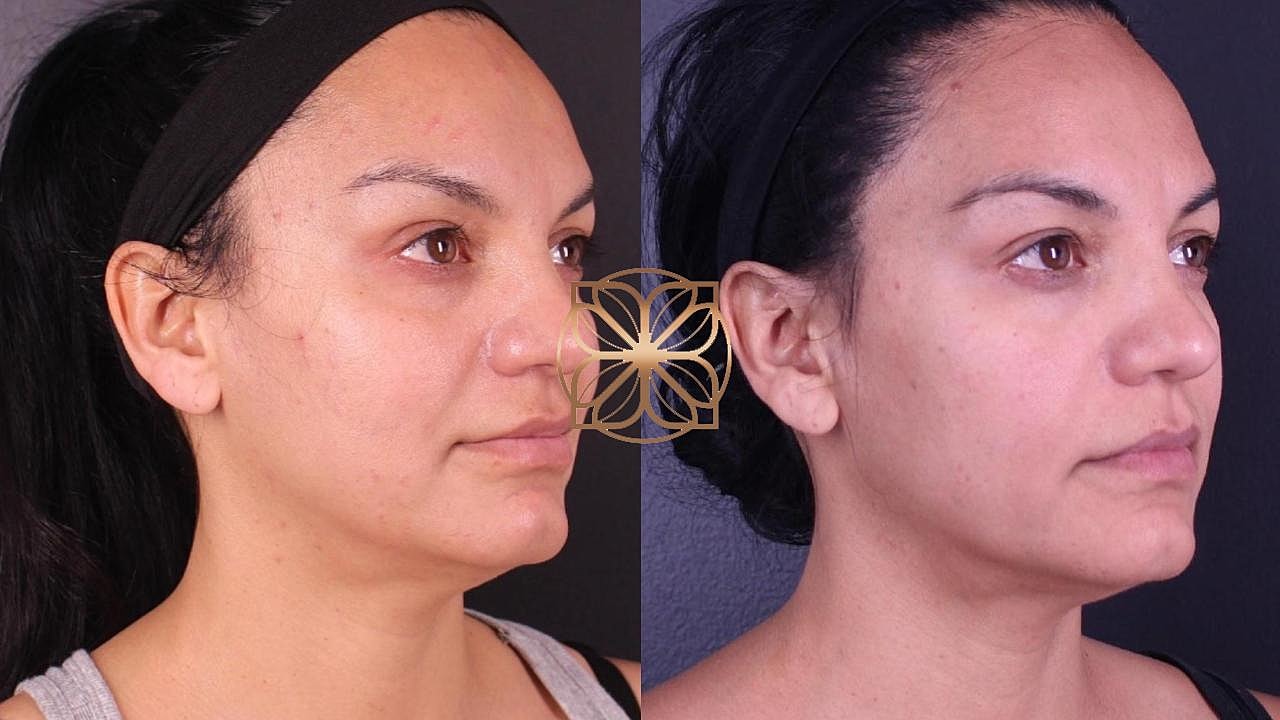 Injectables Gallery Before & After