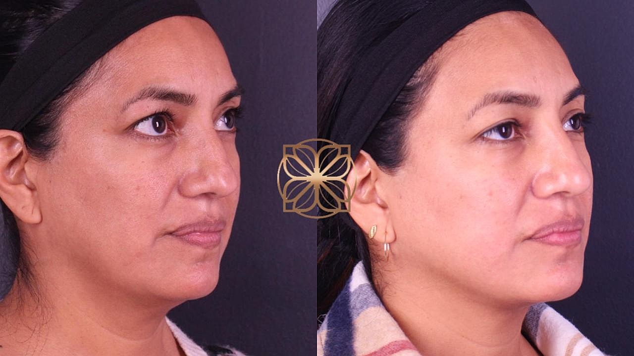 Injectables Gallery Before & After