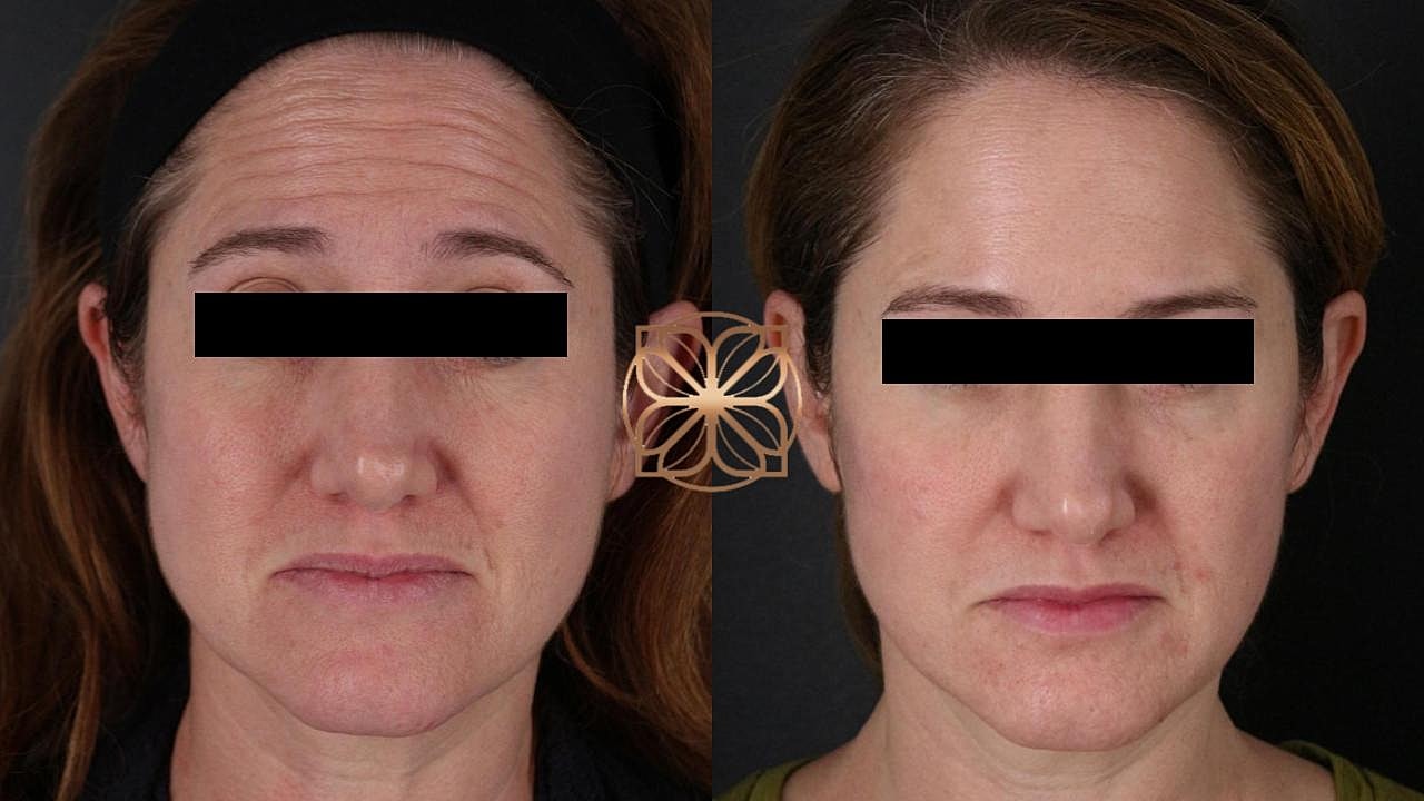 Injectables Gallery Before & After