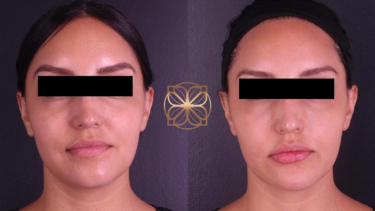 Injectables Gallery Before & After