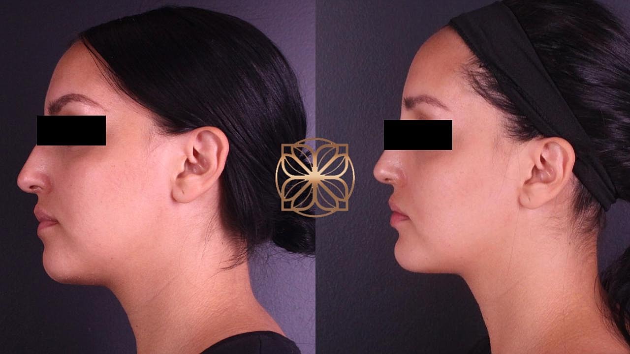 Injectables Gallery Before & After