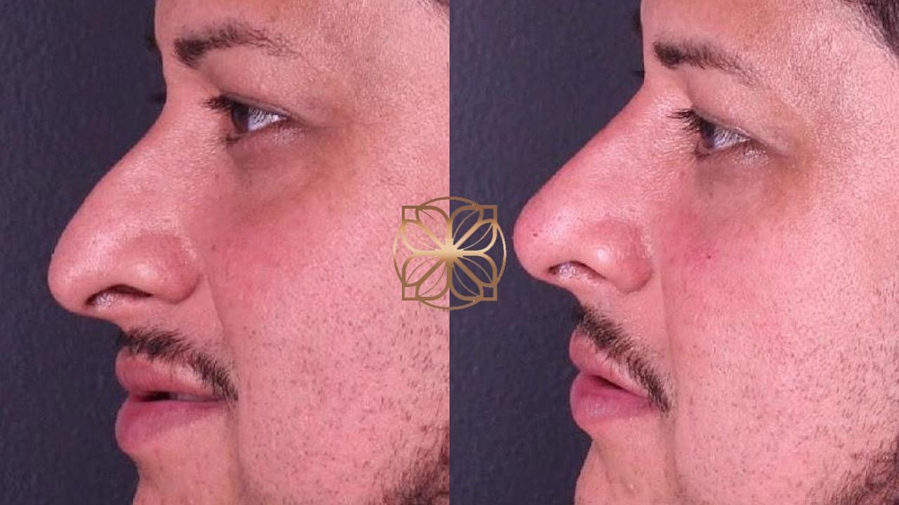 Injectables Gallery Before & After